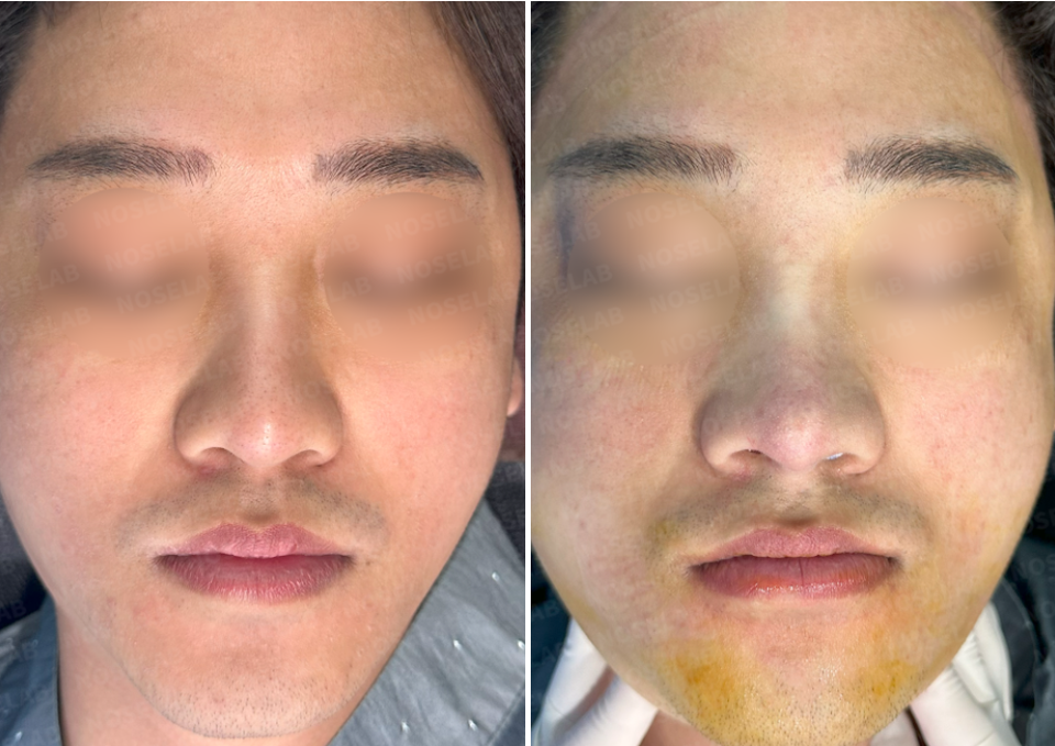 Before surgery (left), After surgery (right)