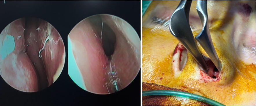 Endoscopic and intraoperative images for emergency revision rhinoplasty: mucosal adhesion observed in the left nasal cavity and inflamed tissue during implant removal.