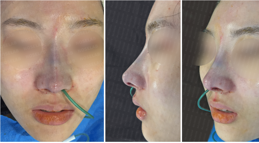 Immediately after hump nose correction surgery – frontal, side, and oblique side view photos