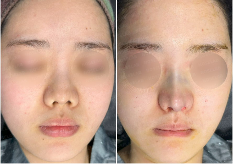 Correcting Nostril Stenosis – Before (left) and immediately after (right) revision rhinoplasty, front view photos showing improved nostril symmetry.