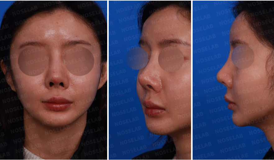 Preoperative photos for emergency revision rhinoplasty: frontal, left profile, and oblique views showing silicone exposure risk and nasal asymmetry.