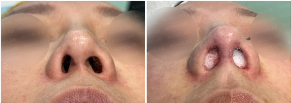 Before and After Surgery Photos. Before surgery (left), after surgery (right)