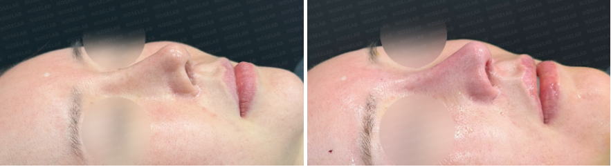 Before and after photos of Upturned Nose Correction surgery: oblique side view comparison (Left: before surgery, Right: immediately after surgery).