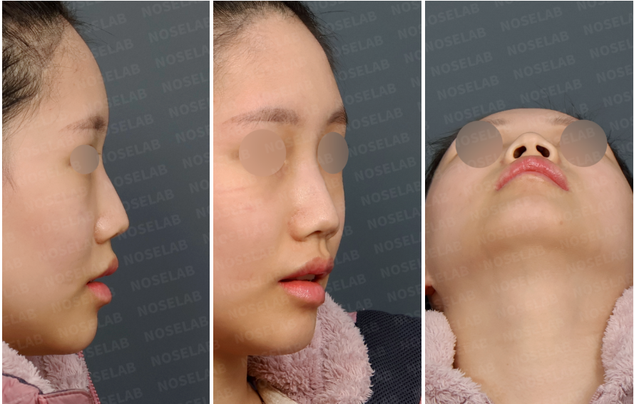 Preoperative design consultation photos showing crooked nasal bridge deviation, drooping nasal tip, and nostril asymmetry from right lateral, right oblique, and basal views.