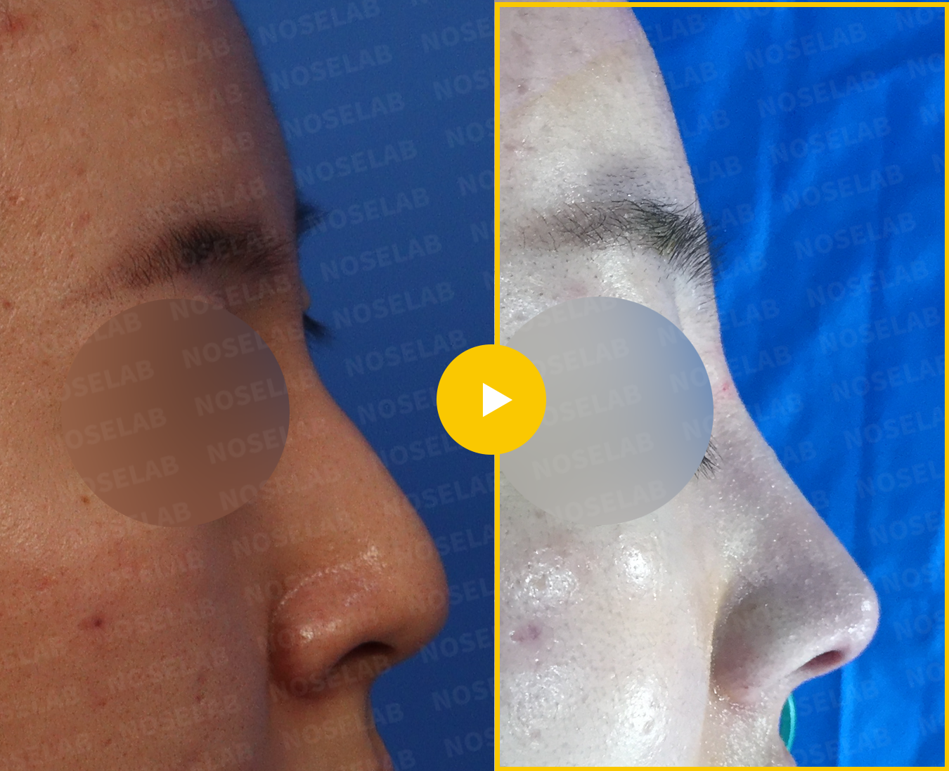 Side profile comparison demonstrating dorsal hump reduction and improved tip position after rhinoplasty