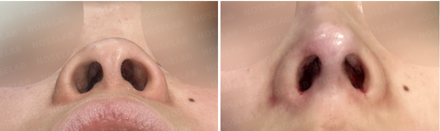 Before and immediately after surgery nostril view showing refined nasal tip structure and improved nostril symmetry following closed rhinoplasty with donor rib cartilage and silicone implant.