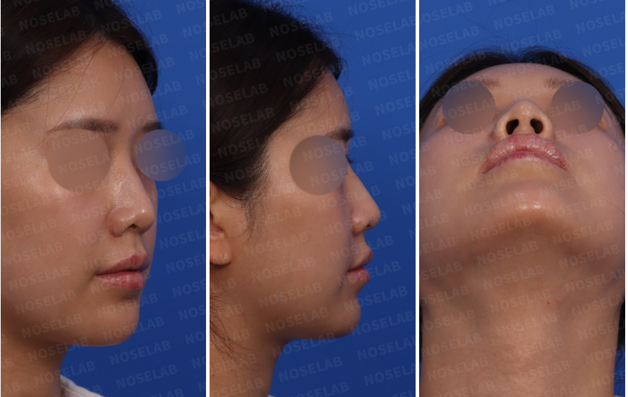Protruding mouth rhinoplasty – pre-surgery design consultation photos, right oblique side, side, and nostril views
