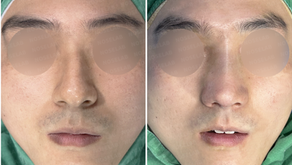 Before and immediately after surgery frontal view showing correction of severe septal deviation and improved nasal alignment following closed rhinoplasty with autologous rib cartilage reconstruction.