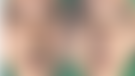 Before and immediately after surgery frontal view showing correction of severe septal deviation and improved nasal alignment following closed rhinoplasty with autologous rib cartilage reconstruction.