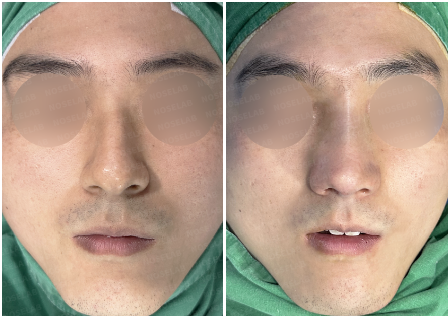 Before and immediately after surgery frontal view showing correction of severe septal deviation and improved nasal alignment following closed rhinoplasty with autologous rib cartilage reconstruction.