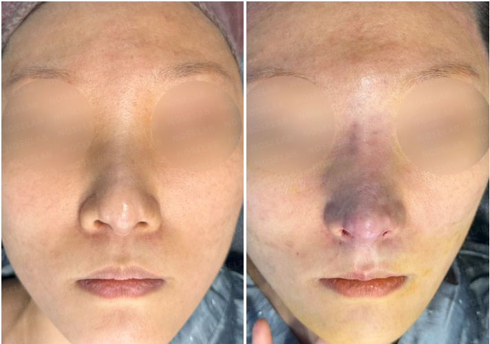 Frontal view before and after rhinoplasty – results of illegal filler removal and reconstruction in Korea.