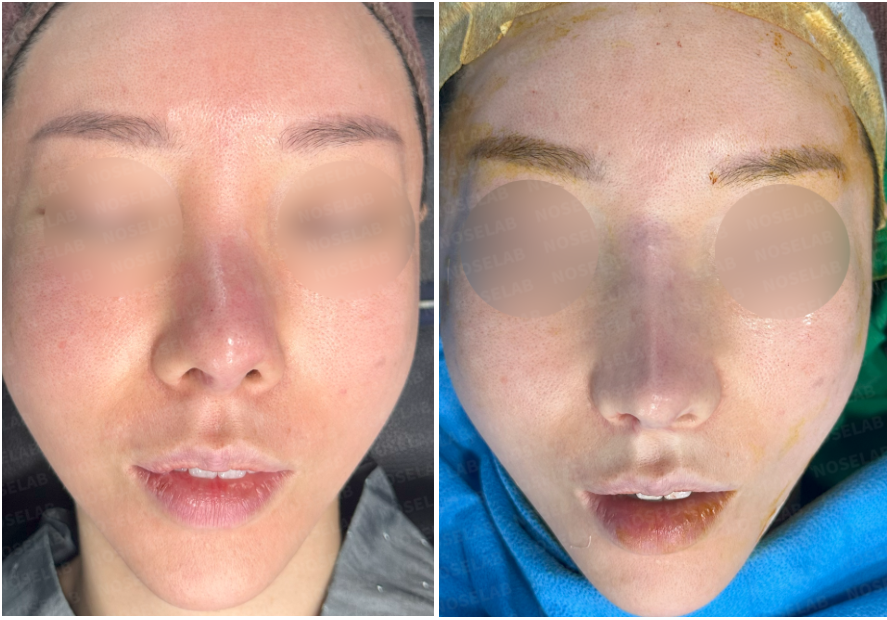 Frontal view before (left) and immediately after (right) revision rhinoplasty for severe nasal contracture – improved nasal symmetry and reduced dorsal irregularities.