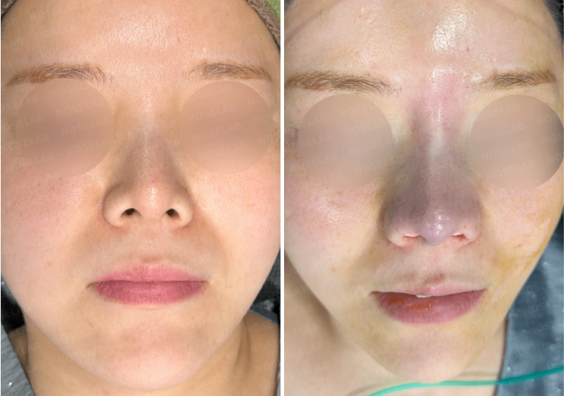 Frontal comparison of patient before surgery (left) and immediately after revision rhinoplasty (right), showing correction of short, crooked nose and nostril asymmetry.