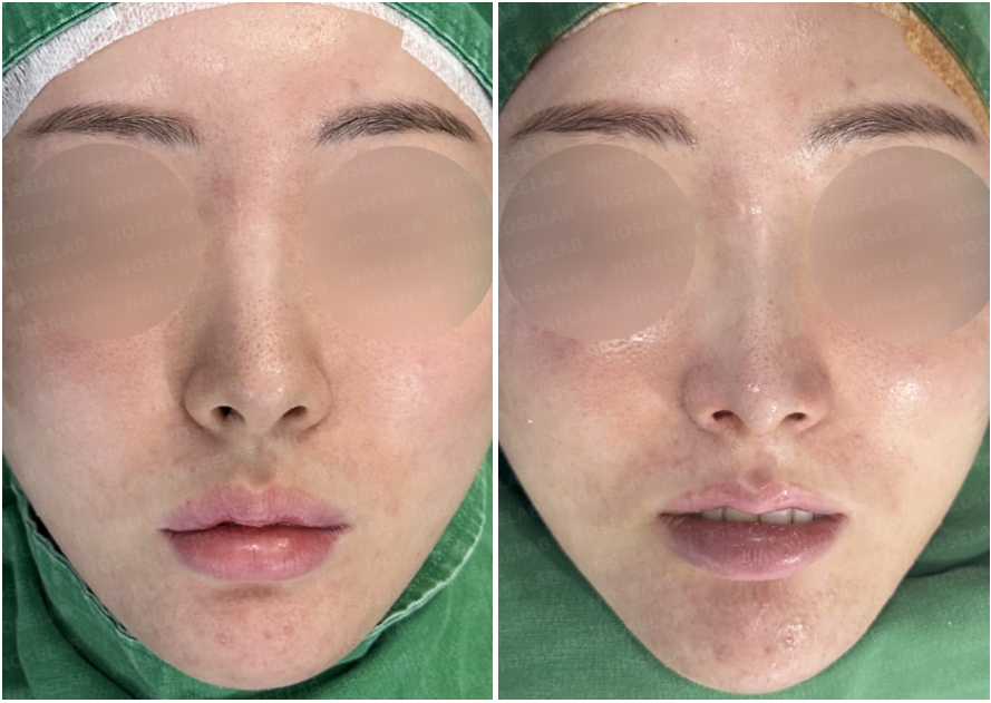 Before and immediately after Feminine Rhinoplasty: frontal view comparison showing correction of nostril asymmetry and refined feminine nasal line.