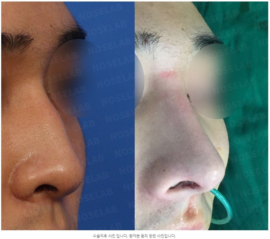 Before and after Closed Rhinoplasty Seoul – 45-degree view showing correction of deviated nose, hump removal, and balanced nasal tip using self rib cartilage at NoseLab.