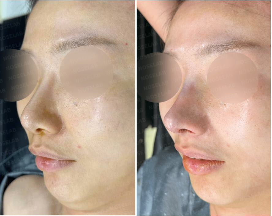 Oblique view before and immediately after revision rhinoplasty showing improved nasal alignment, smoother dorsal contour, and refined nasal tip projection