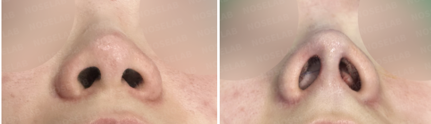 Nostril view comparison showing preoperative nasal appearance on the left and immediate postoperative condition on the right after nasal bridge refinement and nasal tip support.
