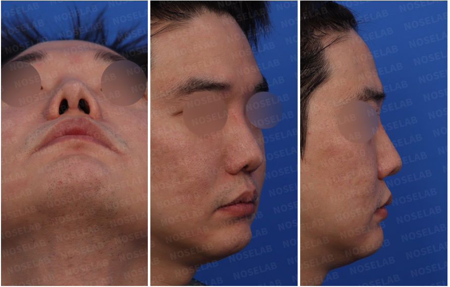 Preoperative consultation photos for Revision Rhinoplasty for Nasal Asymmetry – right side view, right oblique side view, and nostril view highlighting columella retraction and nostril imbalance