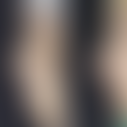 Crooked hump nose and droopy tip correction before and after rhinoplasty Korea