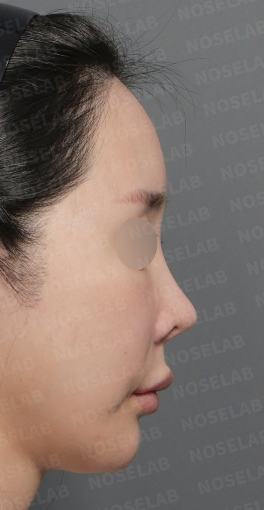 Preoperative consultation: right profile.