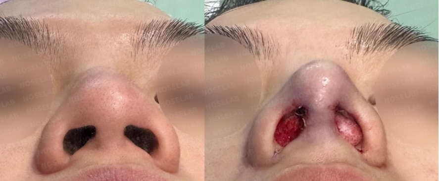 Before and after nostril base view – improved nasal tip projection and symmetry after droopy and deviated nose correction with self-rib cartilage (Noselab Clinic)