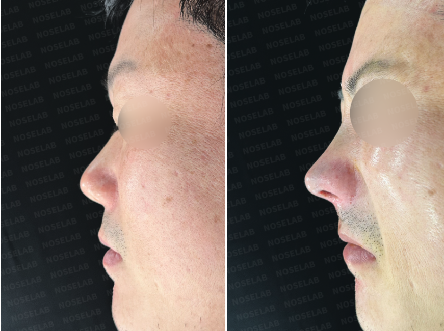 Short and Upturned Nose Correction – side view before (left) and immediately after (right) closed rhinoplasty.