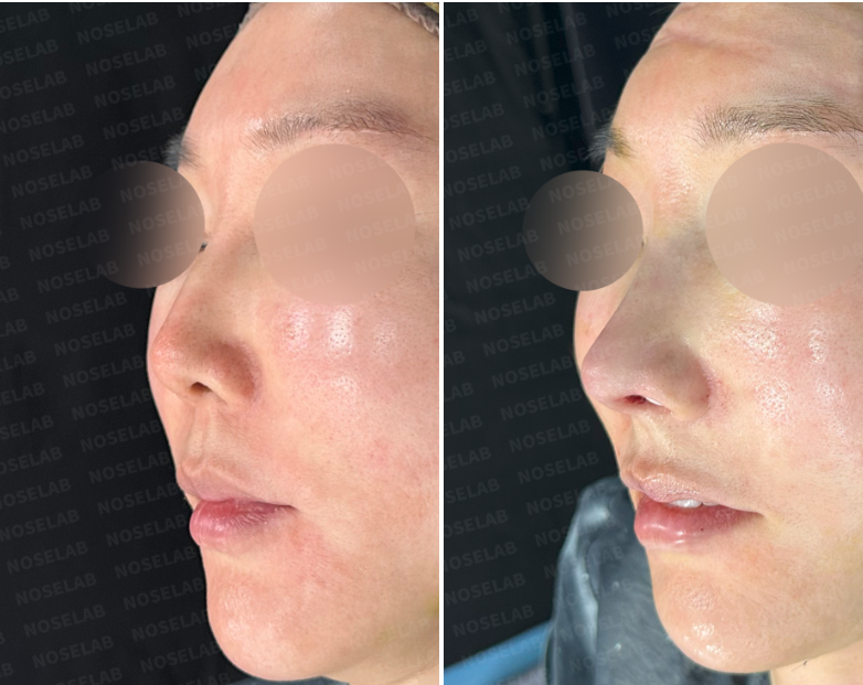 ight oblique view before revision rhinoplasty (left) and immediately after surgery (right) – nasal tip refined and nostril exposure corrected.