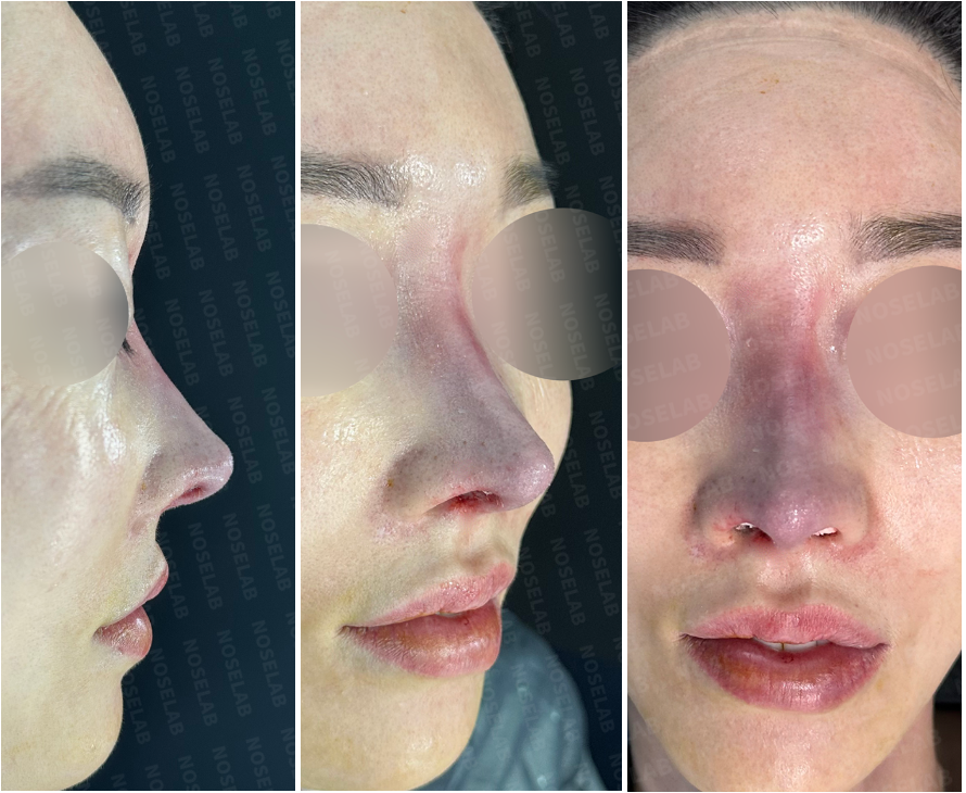 Immediate postoperative photos after long nose correction – side profile, 45-degree oblique, and frontal views showing refined tip and smoother nasal bridge.