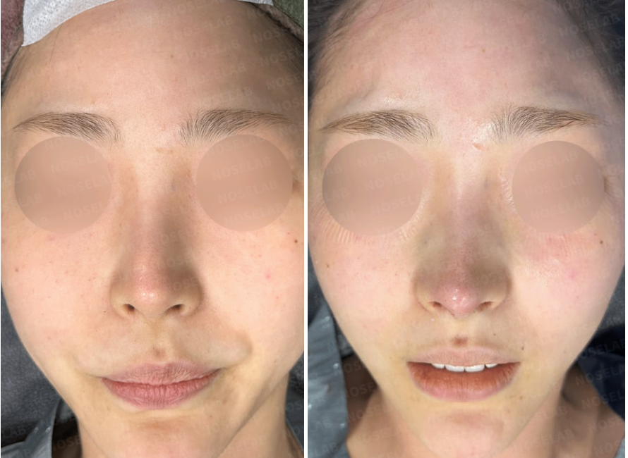 Correcting Drooping Nasal Tip and Nasal Obstruction – Before and Immediately After frontal view rhinoplasty at Nose Lab Clinic