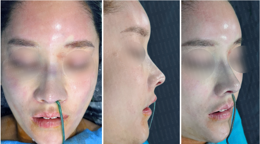 Protruding mouth rhinoplasty – immediate post-surgery photos, frontal, 45-degree angle, and side profile views