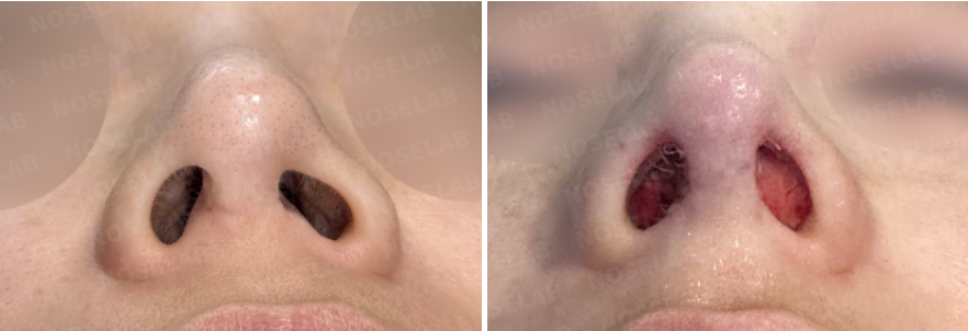 Nostrils before surgery (left), After surgery (right)