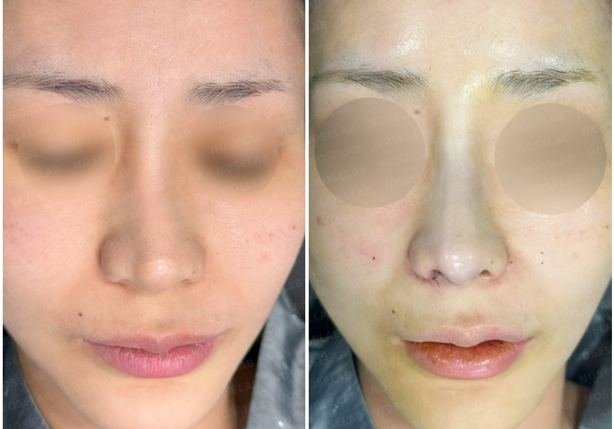 Post-Orthognathic Septal Reconstruction before-and-after comparison – frontal view showing nasal symmetry improvement and refined contour immediately after closed rhinoplasty revision.