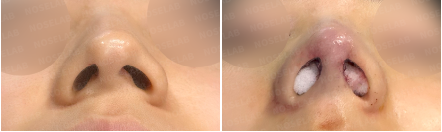 Before and immediately after hump nose correction – basal view showing improved nostril symmetry and refined columella contour.