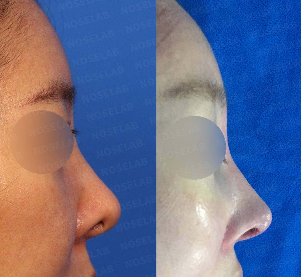 Side-by-side lateral comparison demonstrating improved nasal profile and tip position following secondary rhinoplasty in Korea
