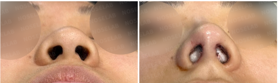 Base view comparison showing the patient's nostrils before surgery (left) and immediately after straight-line rhinoplasty with nostril correction (right).