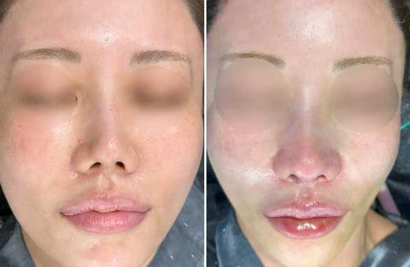 Frontal view before surgery (left) after surgery (right)