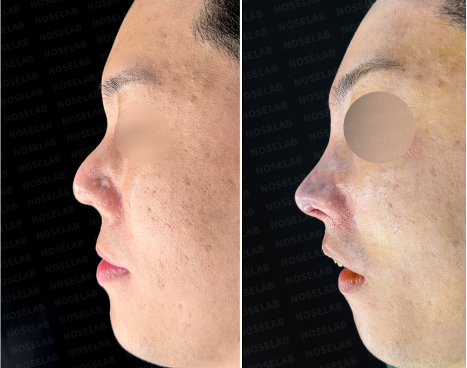 Before and after side profile view of nasal contracture reconstruction with rib cartilage graft and closed rhinoplasty