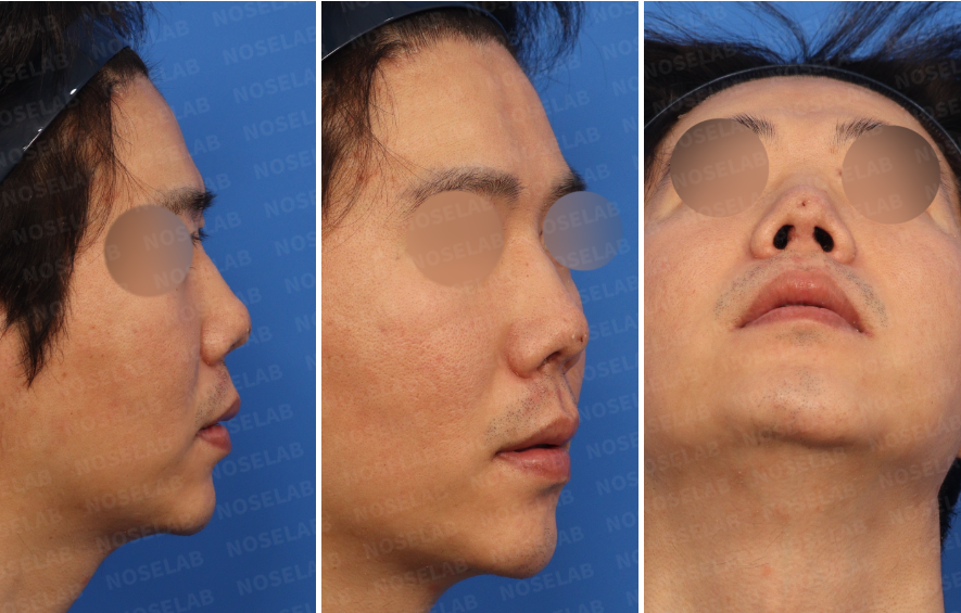 Right-side, oblique side, and nostril view photos of a male patient taken during design consultation for revision rhinoplasty at Nose Lab Clinic.