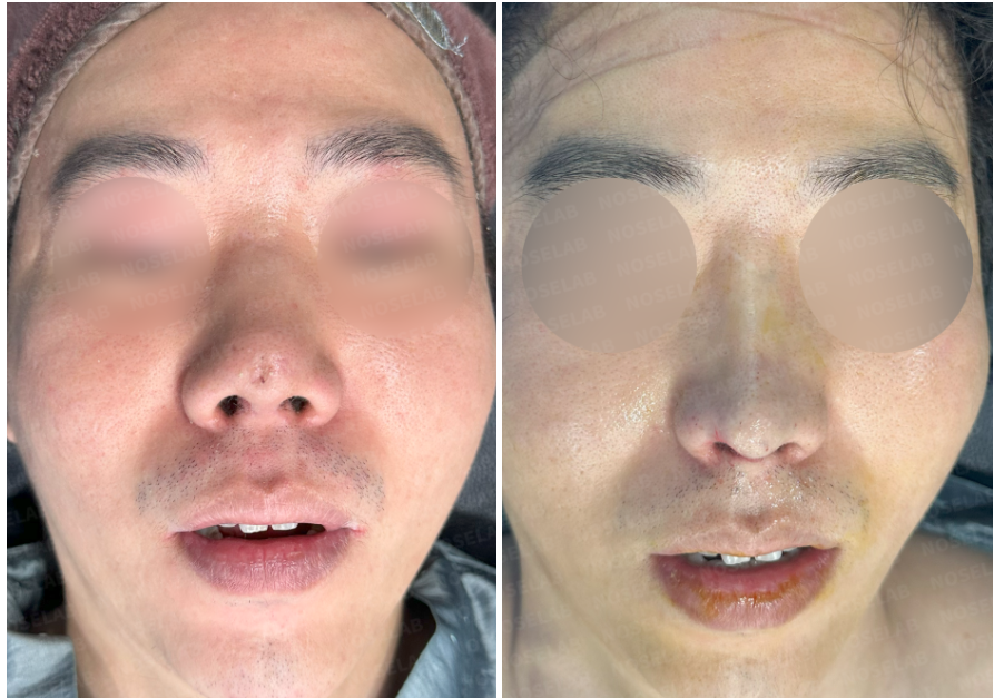 Frontal view comparison photos of a male patient before surgery (left) and immediately after revision rhinoplasty (right) at Nose Lab Clinic.