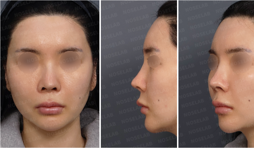 Preoperative consultation images showing frontal view, left oblique view, and left lateral view of a patient with severe nasal obstruction after multiple rhinoplasty surgeries, demonstrating structural nasal collapse and airway compromise.