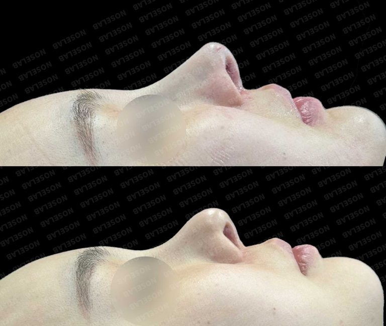 Lateral profile comparison showing nasal length restoration and tip refinement following revision rhinoplasty at Seoul clinic
