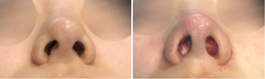 Basal (nostril) view comparison before and immediately after autologous rib cartilage nose surgery – highlighting nostril asymmetry correction and columella repositioning.