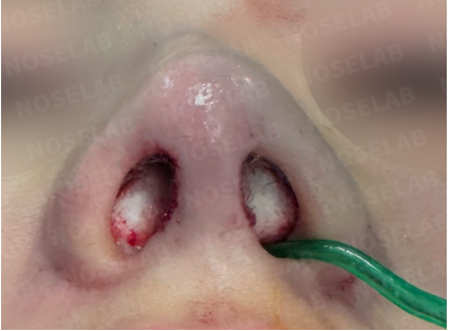 Photo of the nostrils immediately after surgery
