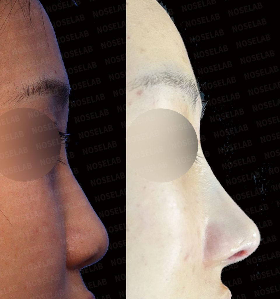 Before and after right lateral photos showing improvement of nasal deviation and projection through Deviated and Small Nose Correction – Closed Rhinoplasty Korea.