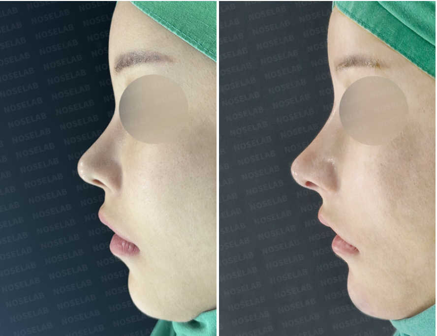 Before and after short nose correction — side view showing extended nasal tip, improved nasolabial angle, and balanced profile line.