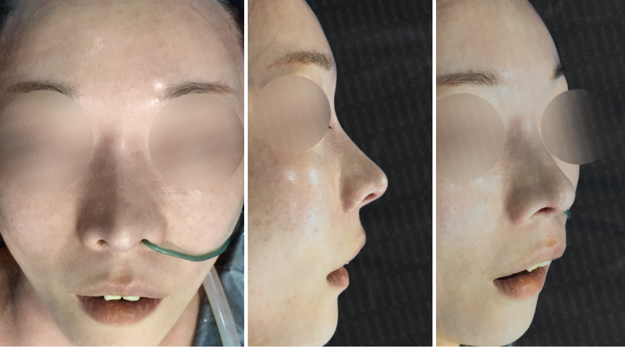 Revision rhinoplasty for short upturned nose – immediate postoperative photos showing frontal, 45-degree oblique, and side views