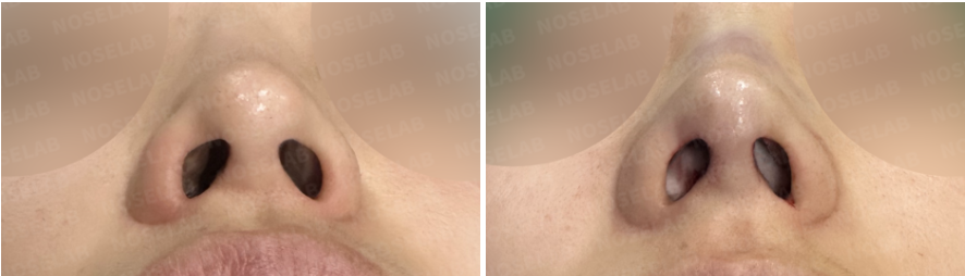 Before and immediately after nostril view showing reduced nostril show, improved symmetry, and stabilized nasal tip support after revision rhinoplasty.