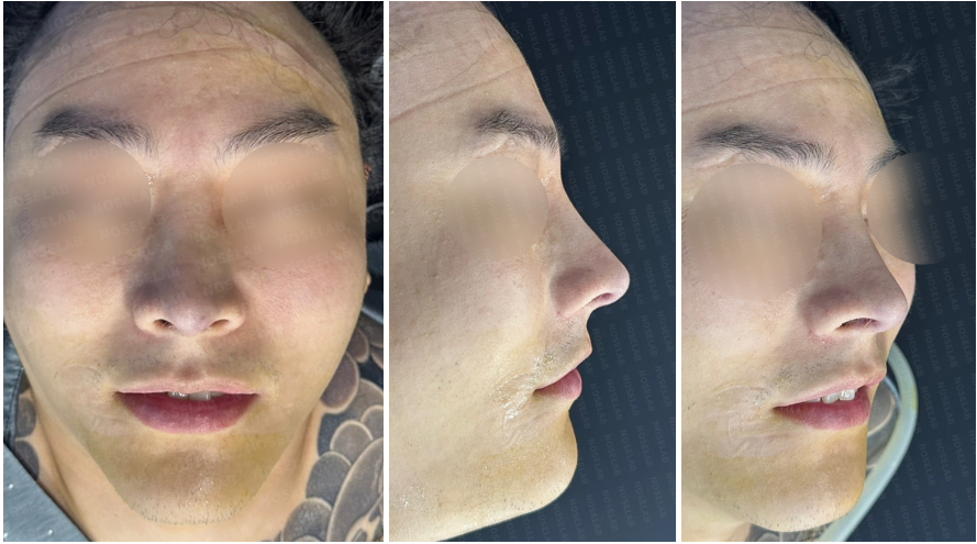 Immediately after male rhinoplasty Korea: frontal view, side profile, and oblique side view showing straightened nasal bridge and corrected tip"