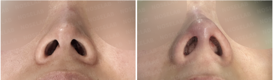 Before and immediately after surgery nostril view comparison showing improved nostril symmetry and stable nasal tip support following primary male rhinoplasty.