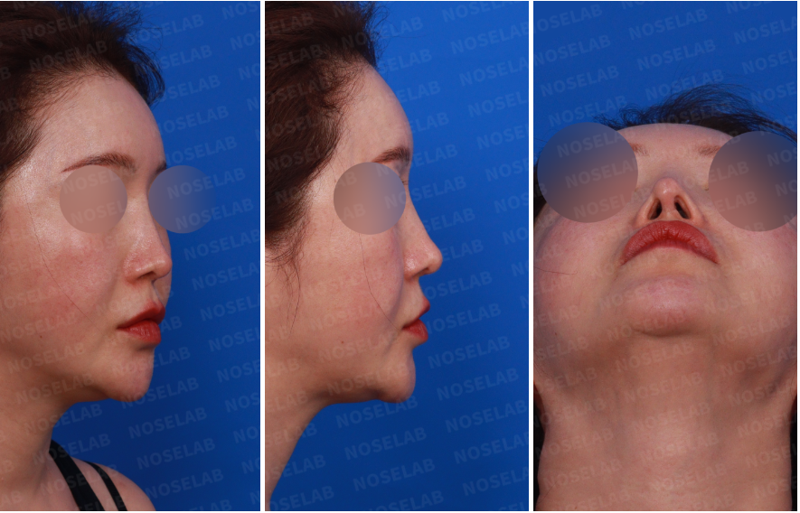 Design consultation photos for contracted nose reconstruction: right side view, oblique side view, and nostril view showing asymmetry and nasal deviation.